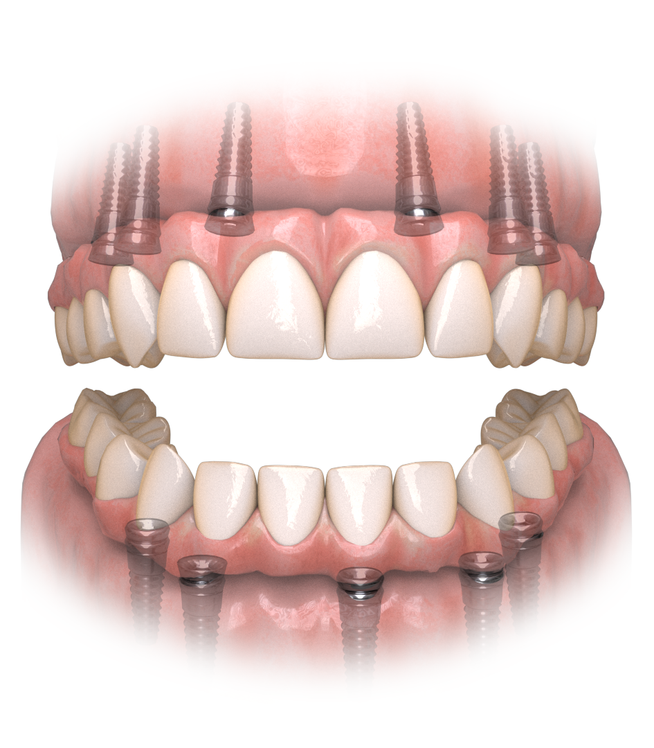 Full Mouth Dental Implants